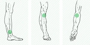 Esclerosis Múltiple
